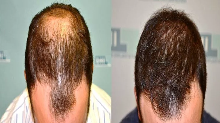 رفع کم پشتی مو با میکرواسکالپ سر در مطب دکتر سید جواد امیریان همراه با 40٪ تخفیف