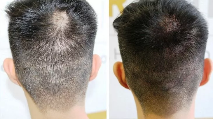 رفع کم پشتی مو با میکرواسکالپ سر در مطب دکتر سید جواد امیریان همراه با 40٪ تخفیف