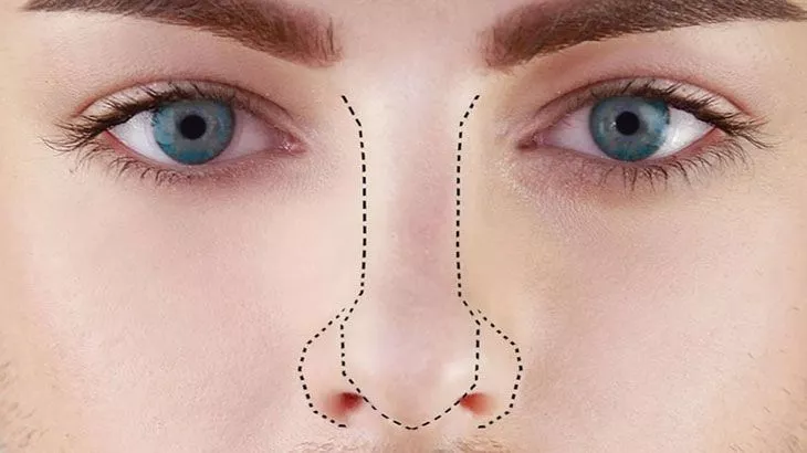کوچک کردن بینی با پلاسما جت همراه با 29% تخفیف ویژه کاربران آفکادو در مطب زیبا آفرین