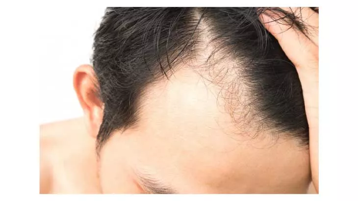 کاشت موی طبیعی در کلینیک به سیما همراه با ۴۰٪ تخفیف و پرداخت ۲۱۰۰۰۰۰ تومان به جای ۳۵۰۰۰۰۰ تومان