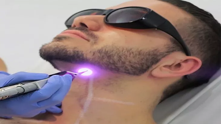 لیزر موهای زائد با دستگاه تیتانیوم 2021 (ویژه آقایان) در مرکز لیزر ابریشم با تخفیف ویژه برای کاربران آفکادو