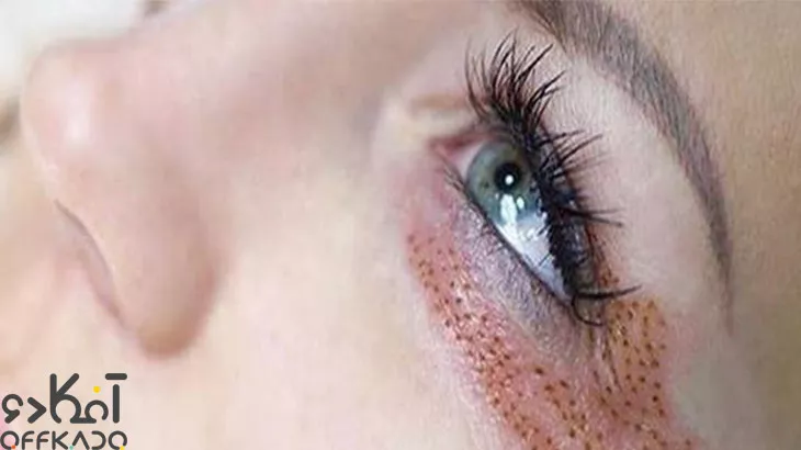 جوانسازی و زیبایی چشم در مرکز لیزر و زیبایی پرتو با تخفیف ویژه برای کاربران آفکادو