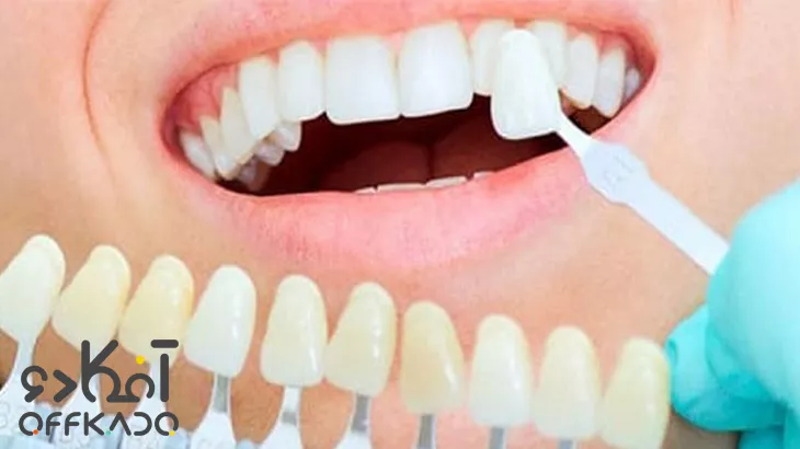 خدمات زیبایی دهان و دندان در کلینیک زیبایی زندیه با تخفیف ویژه آفکادو